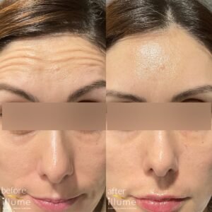 Buy Botox Near Me