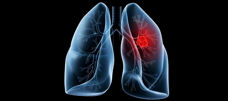 Understanding Rebound Pneumonitis Keytruda: Causes, Symptoms, and Management Best Analysis 2025 2