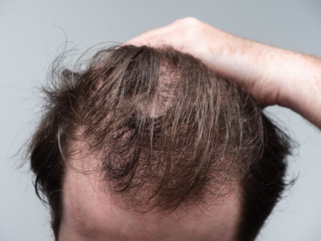 Does Mounjaro Cause Hair Loss? Best Comprehensive Guide 2025 1