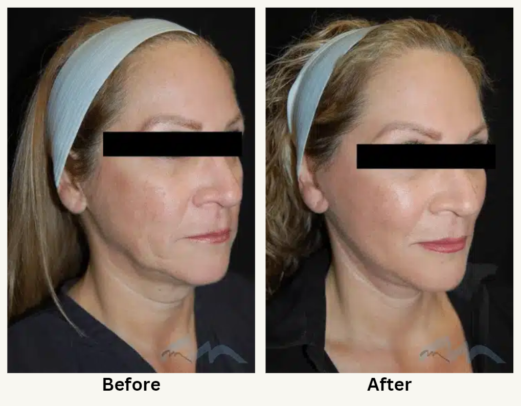 Plastic Surgeons and Ozempic Face: Everything You Need to Know, Best Analysis 2025 4