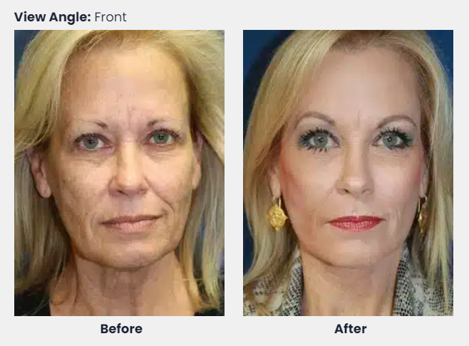 Plastic Surgeons and Ozempic Face: Everything You Need to Know, Best Analysis 2025 3