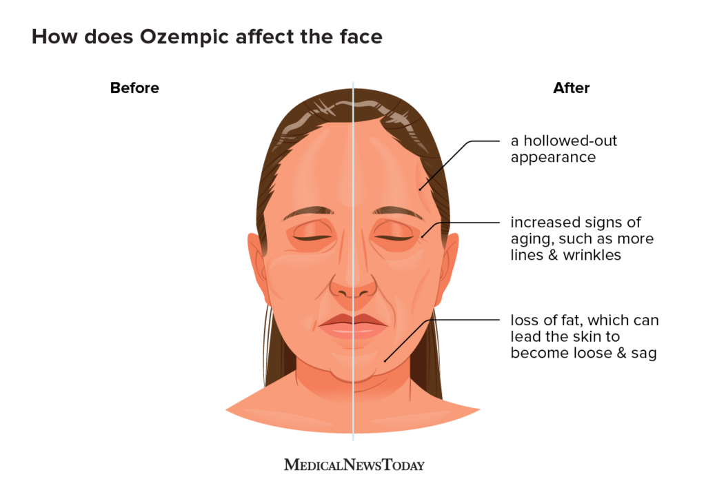 The Science Behind Ozempic Was Wrong? Exploring Myths, Facts, and Controversies 2025 4