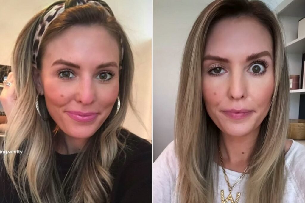 bad sculptra before and after
