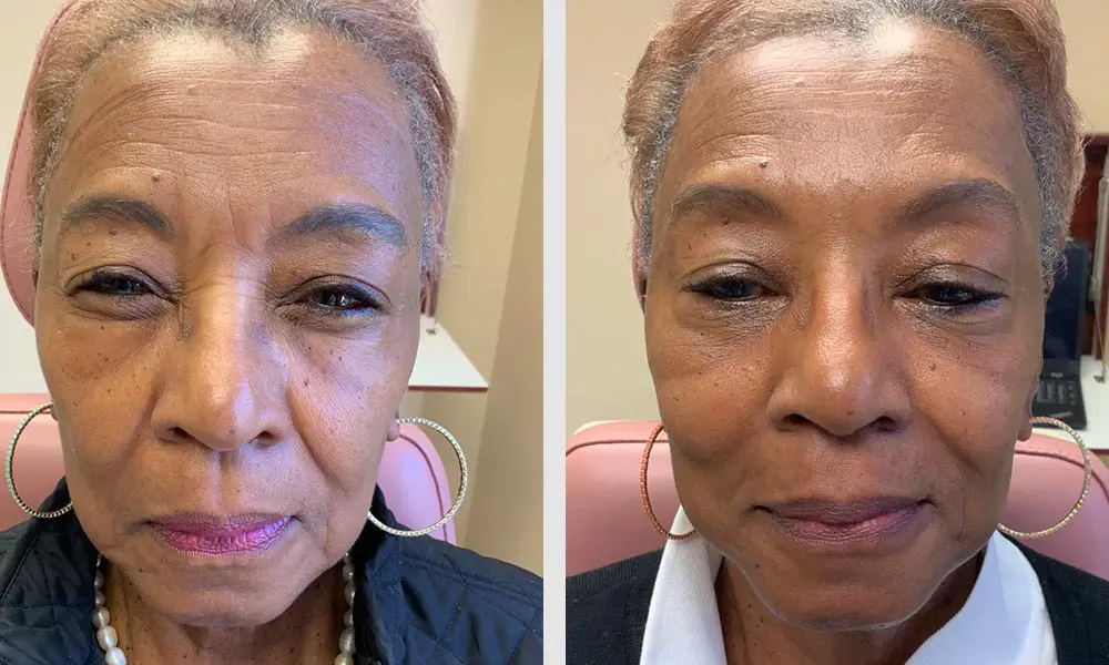 Botox Before and After: A Comprehensive Guide to Transformations, Expectations, and Results 2025 1