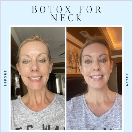 Botox Near Me: A Comprehensive Guide to Finding the Best Providers 2025 2