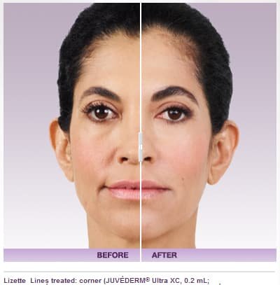 Juvederm Before and After: A Complete Guide to Transformative Results 2025 2