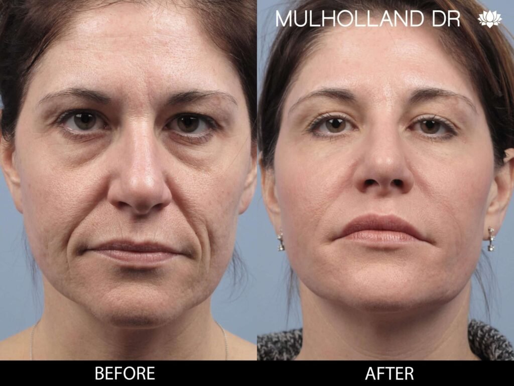 Juvederm Before and After: A Complete Guide to Transformative Results 2025 4