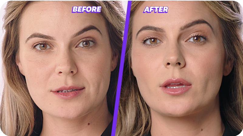 Juvederm Fillers Near Me: Find the Best Providers for a Natural, Youthful Look 2025 4