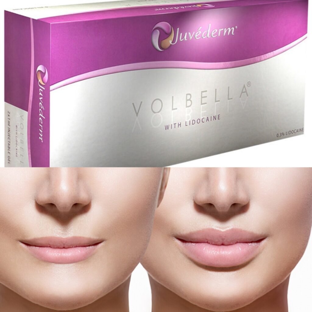 Juvederm Volbella: The Perfect Solution for Subtle Lip Enhancement and Fine Lines 2025 4