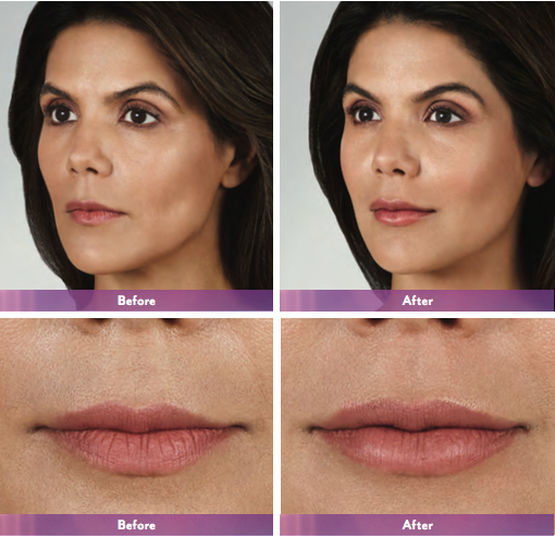 Juvederm Volbella: The Perfect Solution for Subtle Lip Enhancement and Fine Lines 2025 1