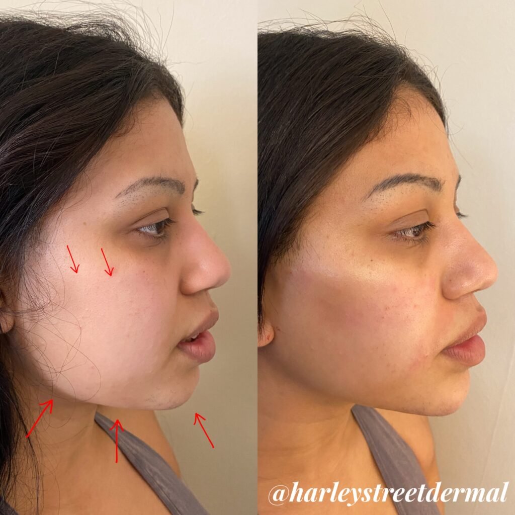 London England Bellafill: The Ultimate Guide to Long-Lasting Skin Rejuvenation 2025 4