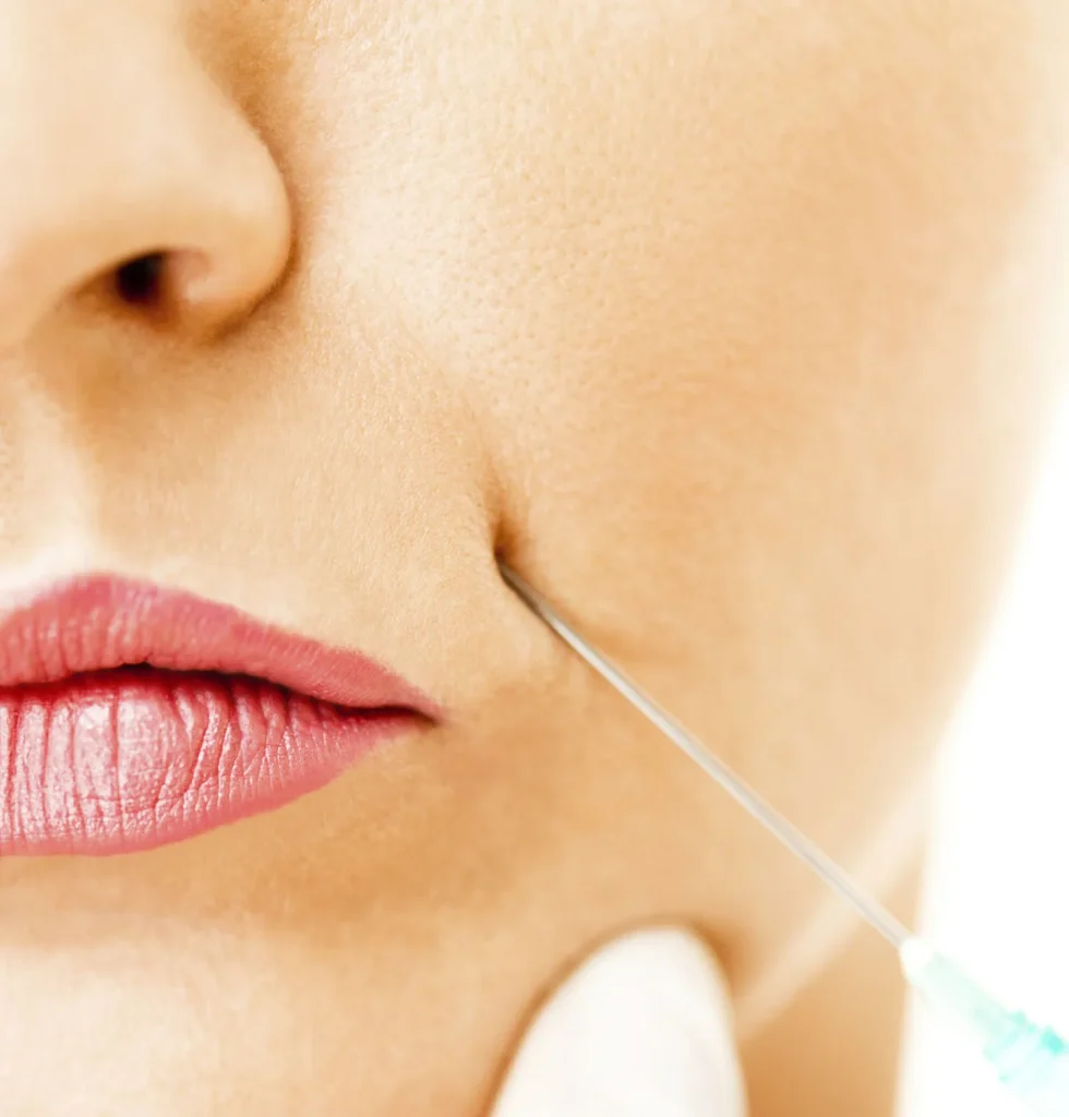 London England Bellafill: The Ultimate Guide to Long-Lasting Skin Rejuvenation 2025 1