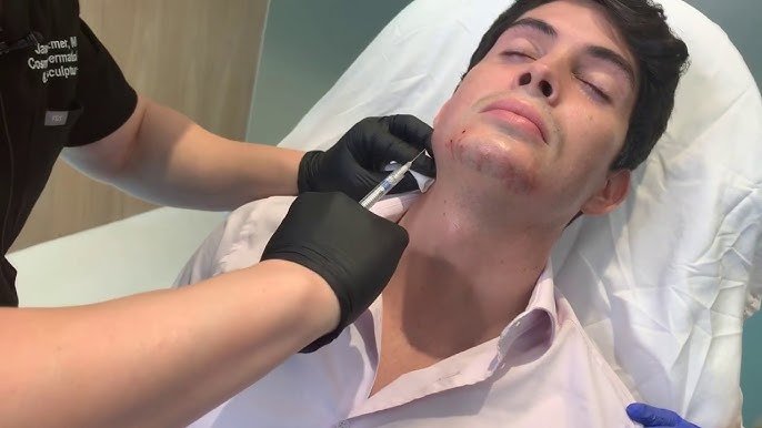 London England Bellafill: The Ultimate Guide to Long-Lasting Skin Rejuvenation 2025 2