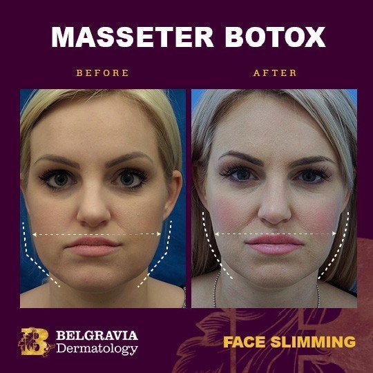 Masseter Botox Before and After: Transforming Your Jawline and Relieving Tension 2025 3