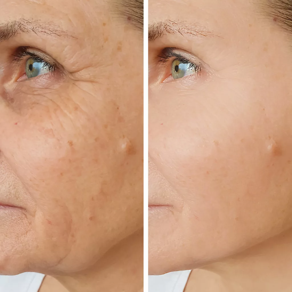 Sculptra Near Me: A Complete Guide to Restoring Volume and Enhancing Your Appearance 2025 3