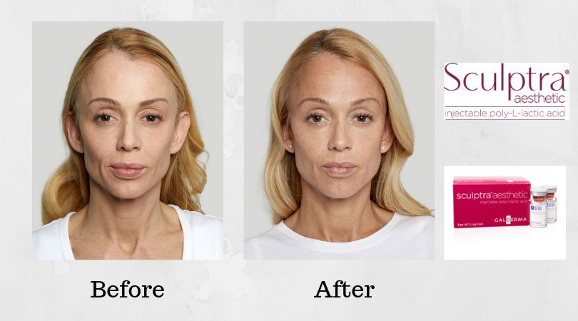 Sculptra Near Me: A Complete Guide to Restoring Volume and Enhancing Your Appearance 2025 1