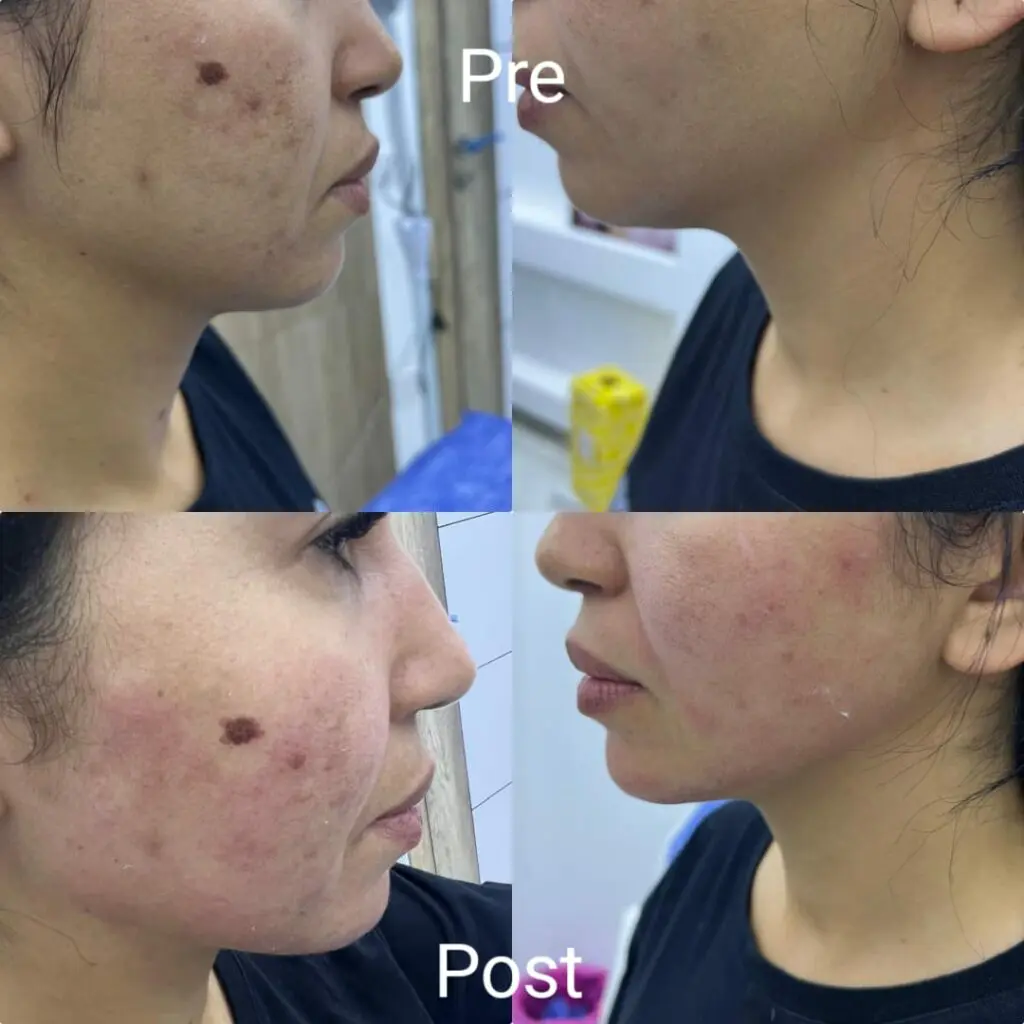 Sculptra Price: What You Need to Know About Costs and Value 2025 3