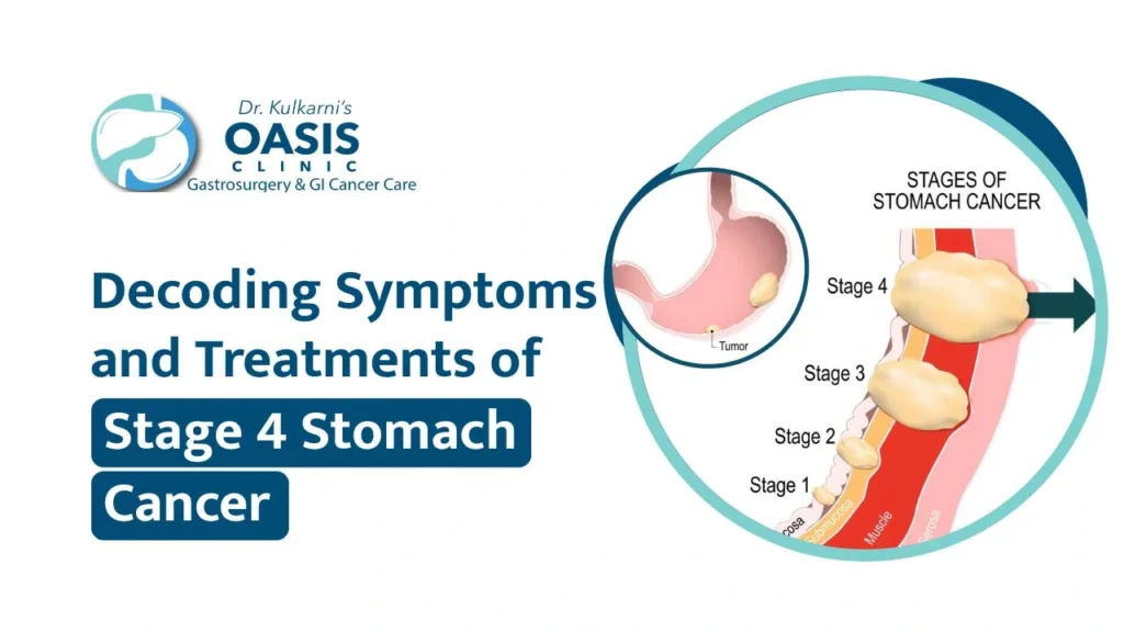 Stomach Cancer Symptoms: Early Warning Signs and What to Watch For, Best Analysis 2025 1